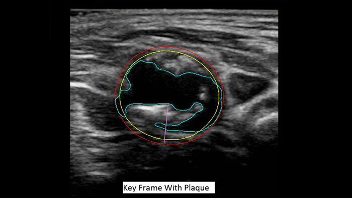 q-app vascular plaque quantification thumbnail