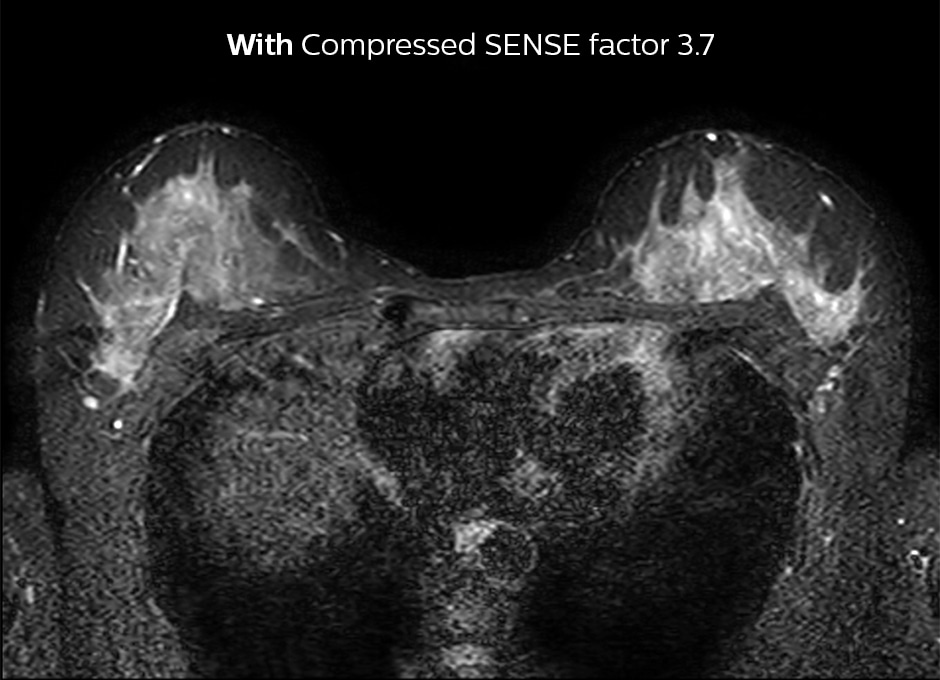 2D STIR breast Compressed SENSE factor3