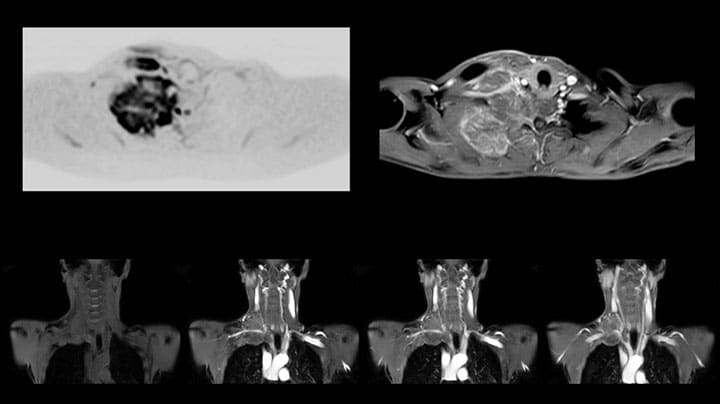 Pancoast tumor MRI