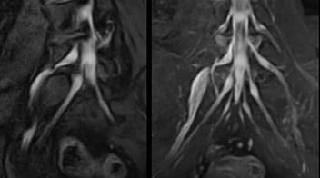 NerveVIEW imaging of right L5 radiculopathy
