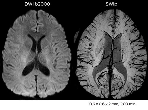 Acute right motor deficit and aphasia A