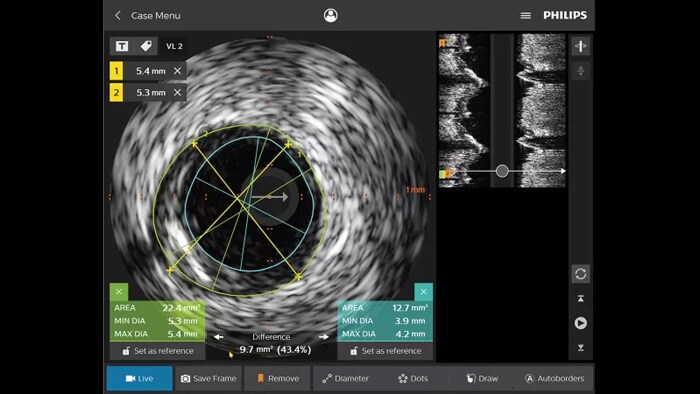 IntraSight angiogram