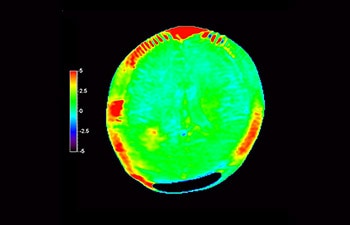 Glioblastoma recurrence