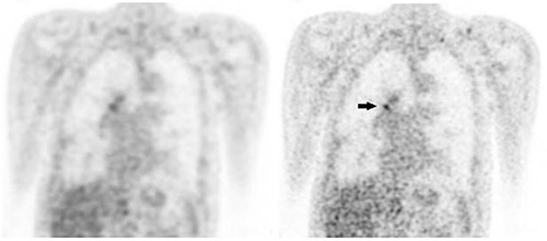 lung cancer image zwolle