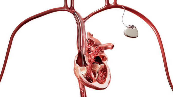 Philips launches new Bridge Plus Occlusion Balloon to help manage rare but life-threatening SVC tears during lead extraction